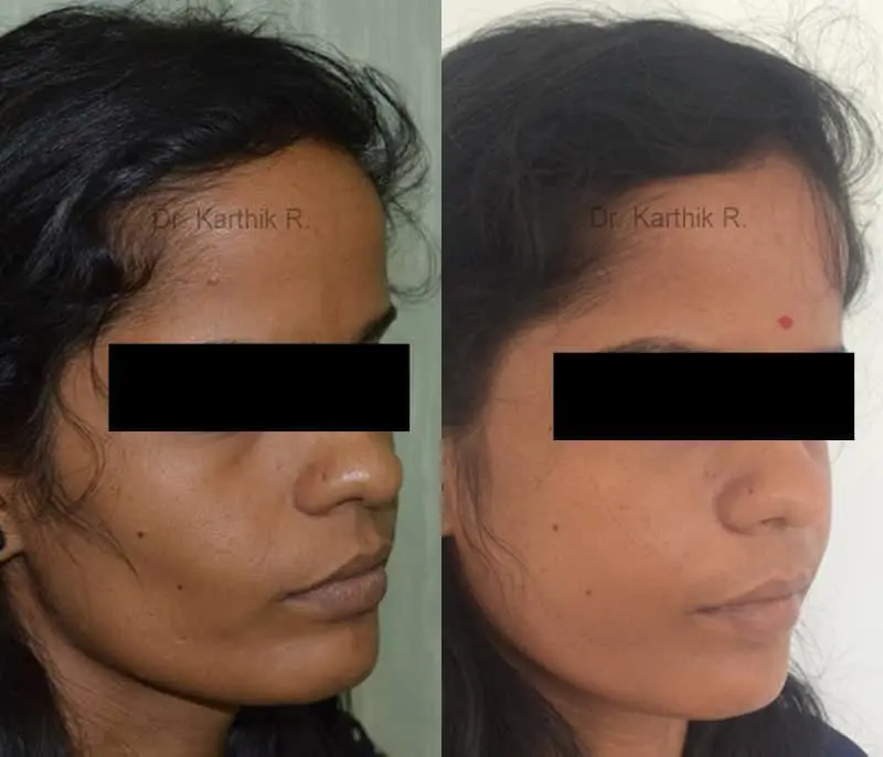 fat graft fat fill fat transfer before and after photo by chennai plastic surgery in india
