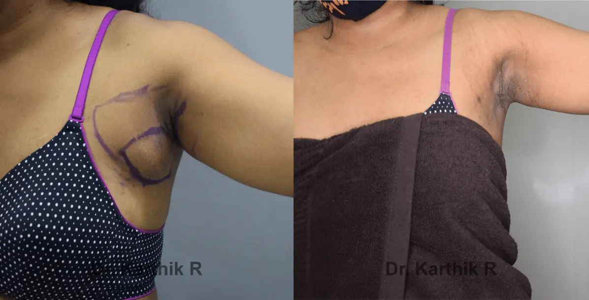 axillary tail of breast before and after photo by chennai plastic surgery in india