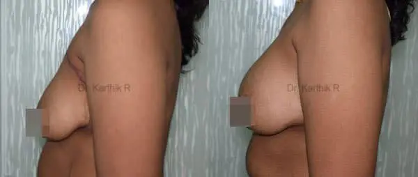 breast fat fill before and after photo by chennai plastic surgery in india