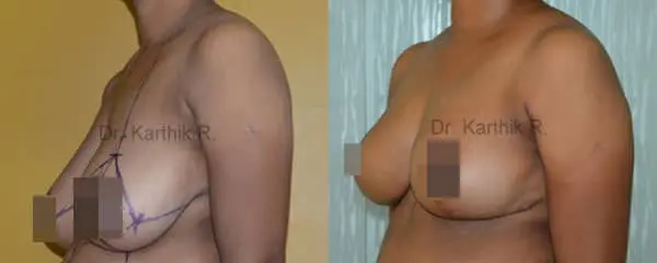 breast reduction breast lift before and after photo by chennai plastic surgery in india