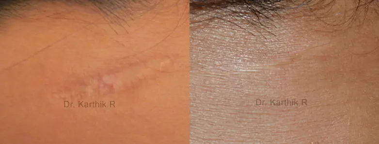 scar revision before and after photo by chennai plastic surgery in india