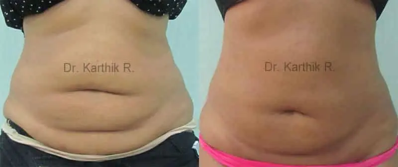 exilis before and after photo by chennai plastic surgery in india