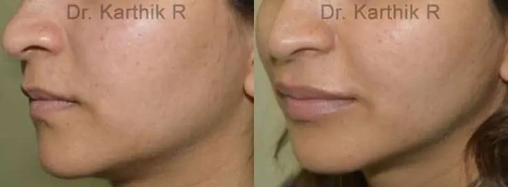 dermal fillers before and after photo by chennai plastic surgery in india