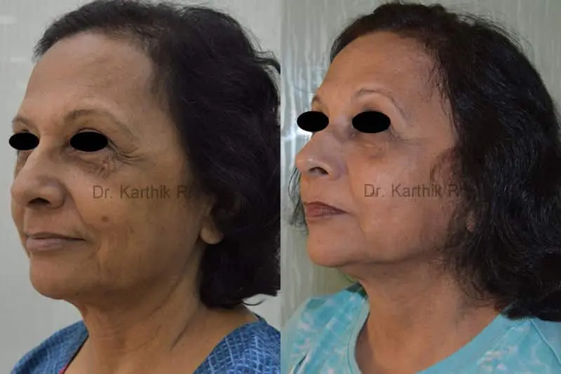 thread lift before and after photo by chennai plastic surgery in india