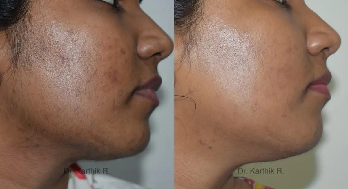 chemical peels microdermabrasion before and after photo by chennai plastic surgery in india