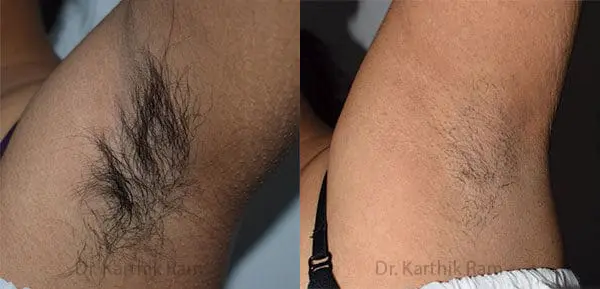 laser hair reduction before and after photo by chennai plastic surgery in india