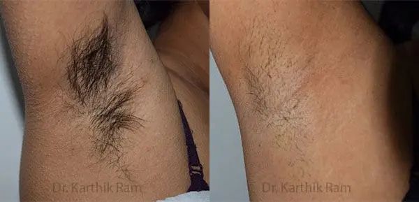 laser hair reduction before and after photo by chennai plastic surgery in india
