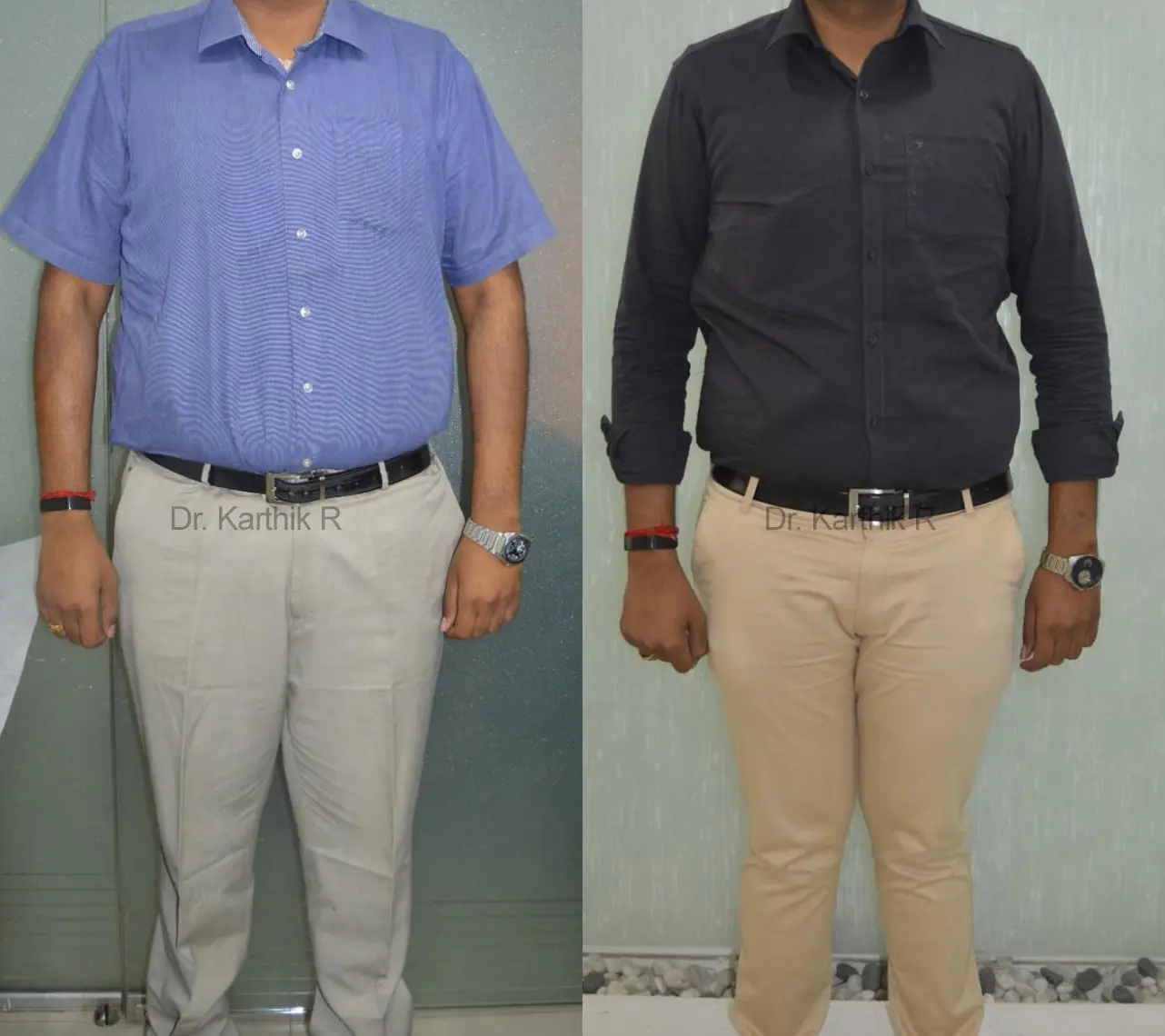 weight loss program before and after photo by chennai plastic surgery in india