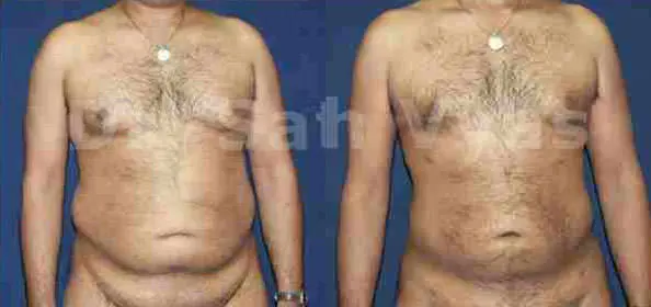 liposuction tummy back before and after photo by chennai plastic surgery in india