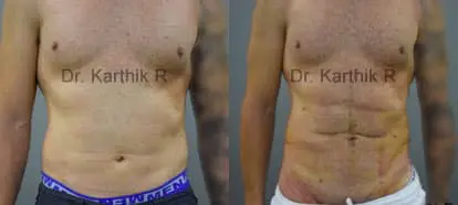 abdominal etching before and after photo by chennai plastic surgery in india