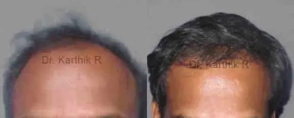 hair transplantation before and after photo by chennai plastic surgery in india
