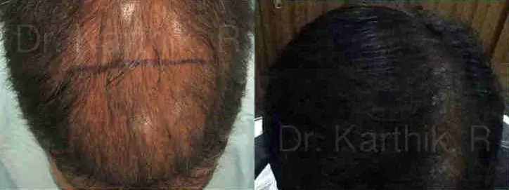 hair transplantation before and after photo by chennai plastic surgery in india