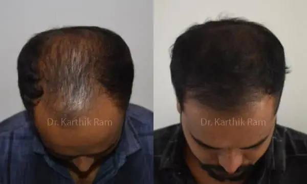 hair transplantation before and after photo by chennai plastic surgery in india
