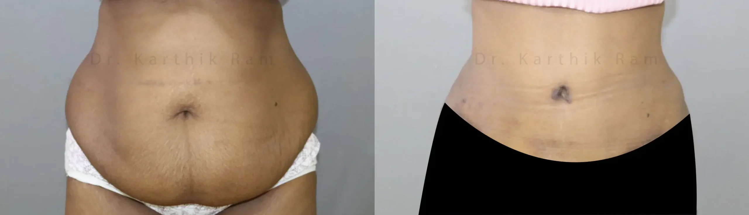 tummy tuck before and after photo by chennai plastic surgery in india