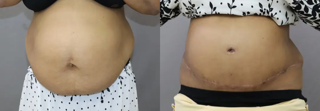 tummy tuck before and after photo by chennai plastic surgery in india