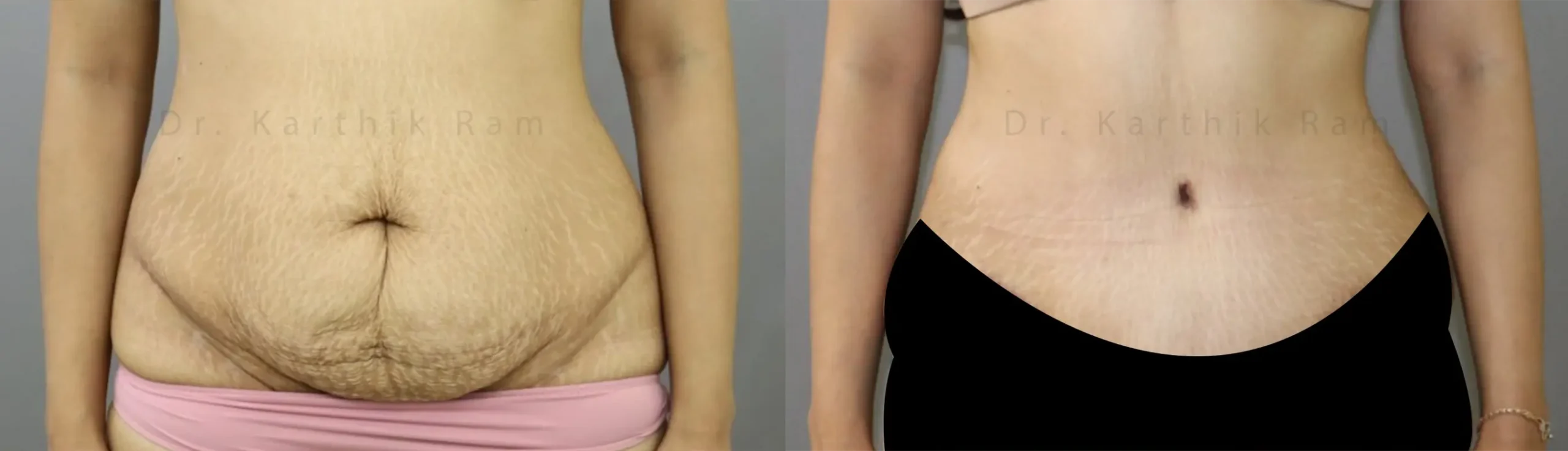 tummy tuck before and after photo by chennai plastic surgery in india