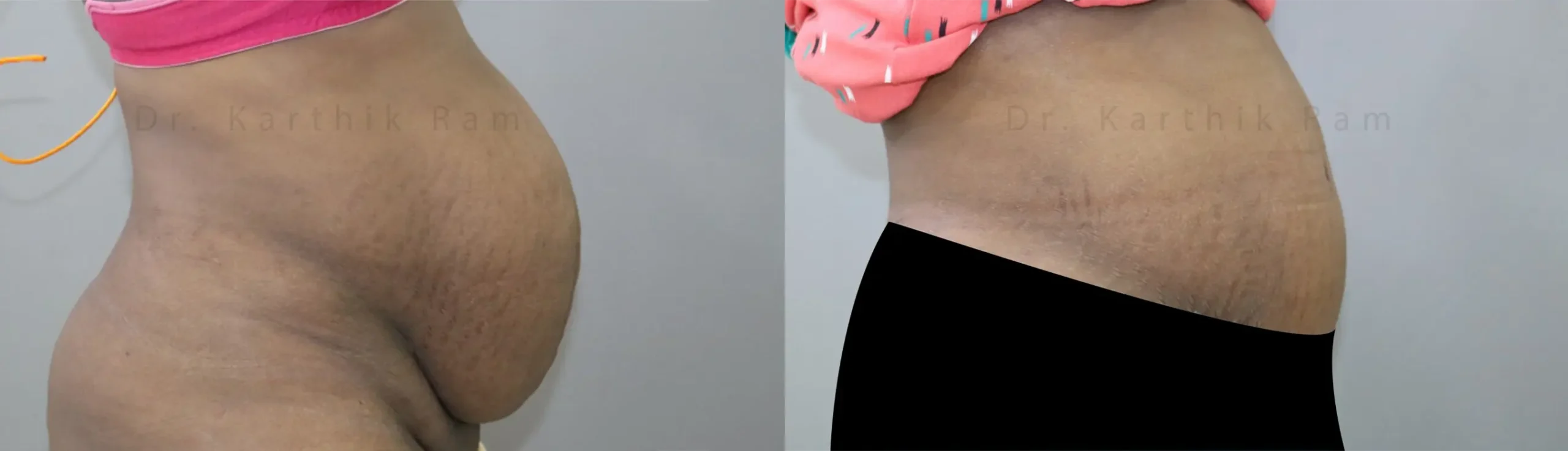 tummy tuck before and after photo by chennai plastic surgery in india