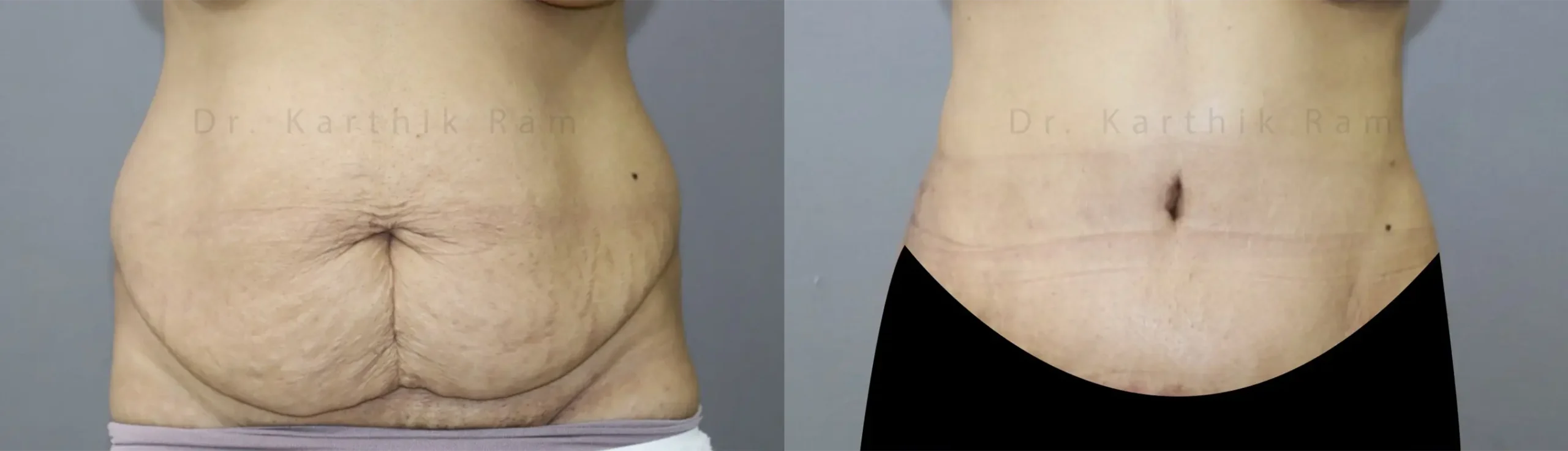 tummy tuck before and after photo by chennai plastic surgery in india