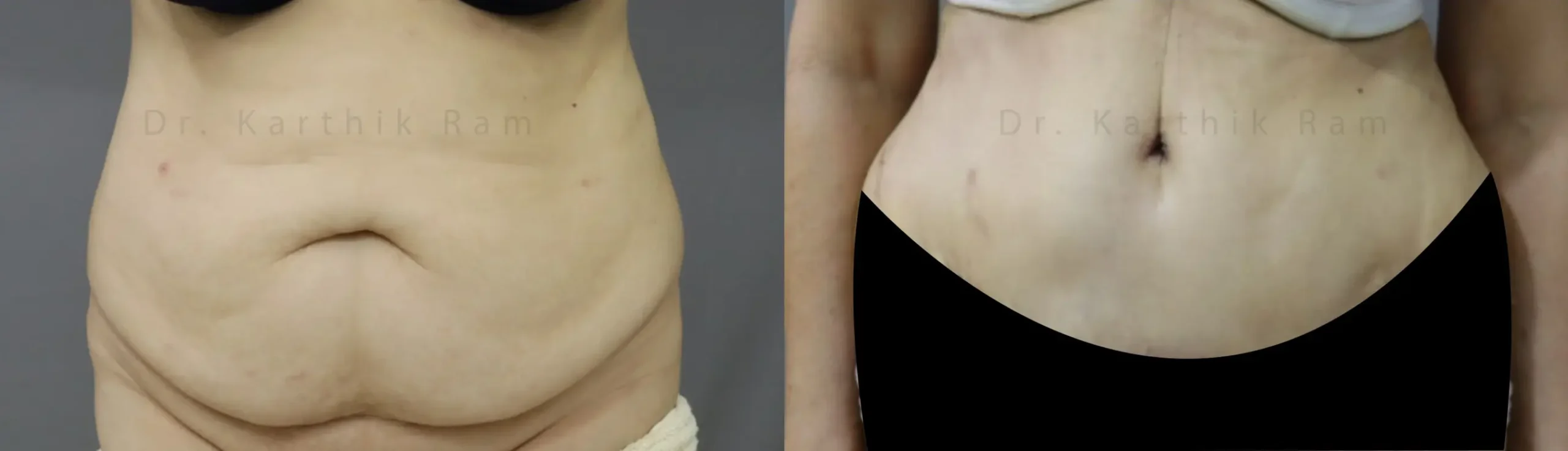 tummy tuck before and after photo by chennai plastic surgery in india