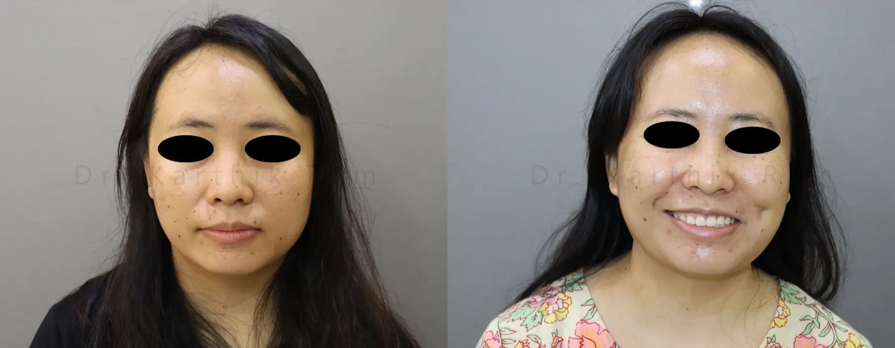 dimple creation before and after photo by chennai plastic surgery in india