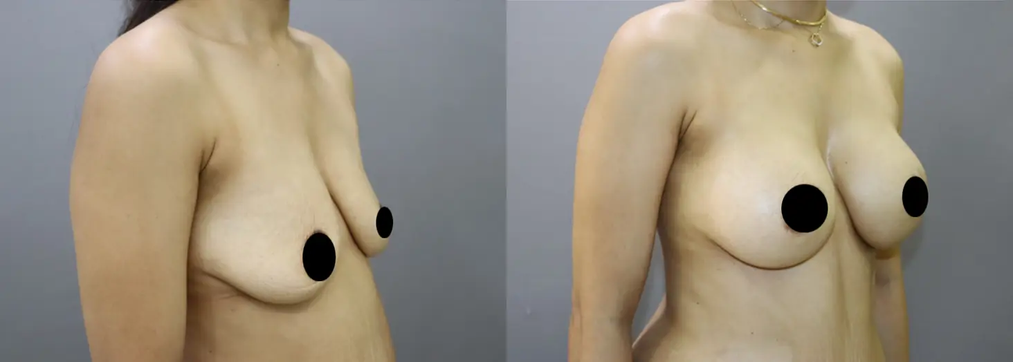 breast implants before and after photo by chennai plastic surgery in india