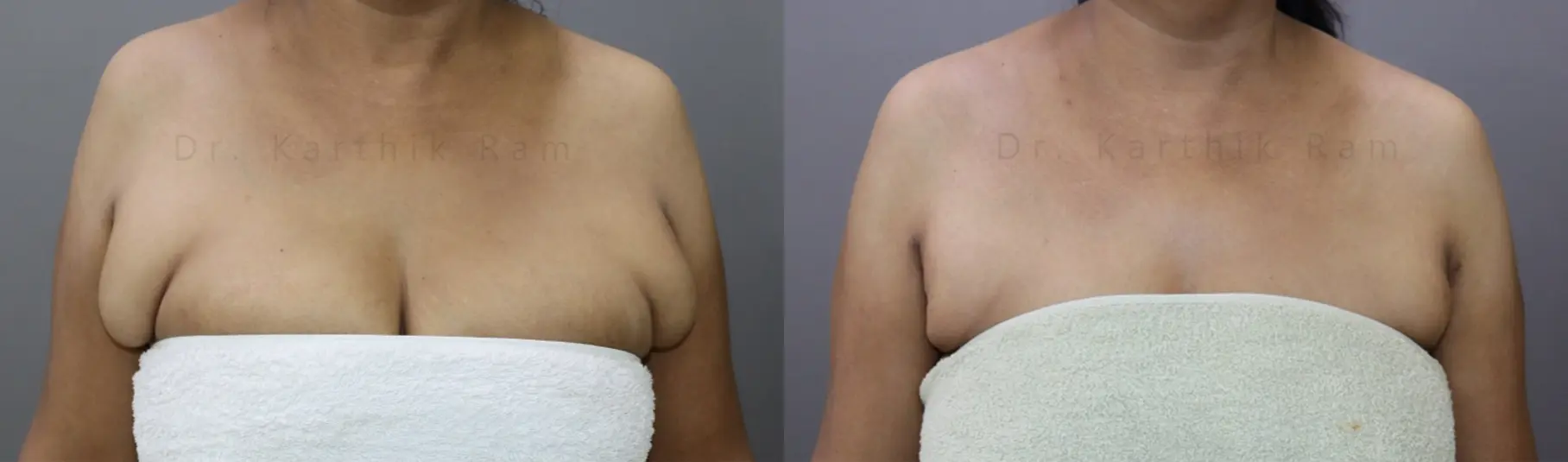 axillary tail of breast before and after photo by chennai plastic surgery in india