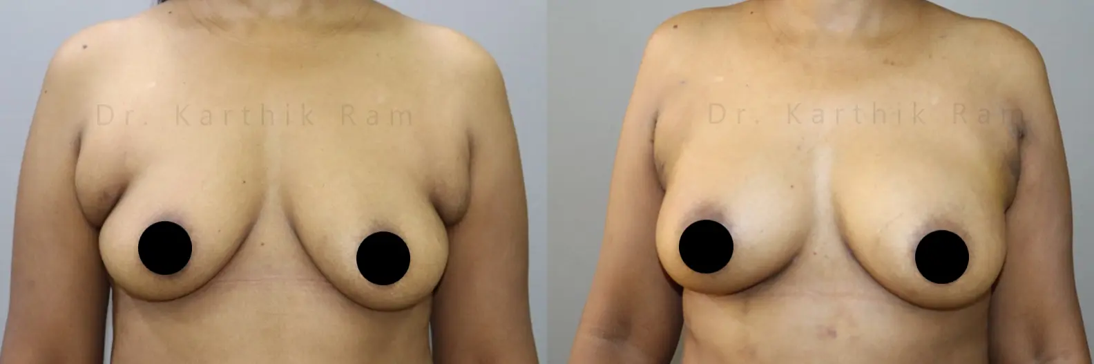 axillary tail of breast before and after photo by chennai plastic surgery in india