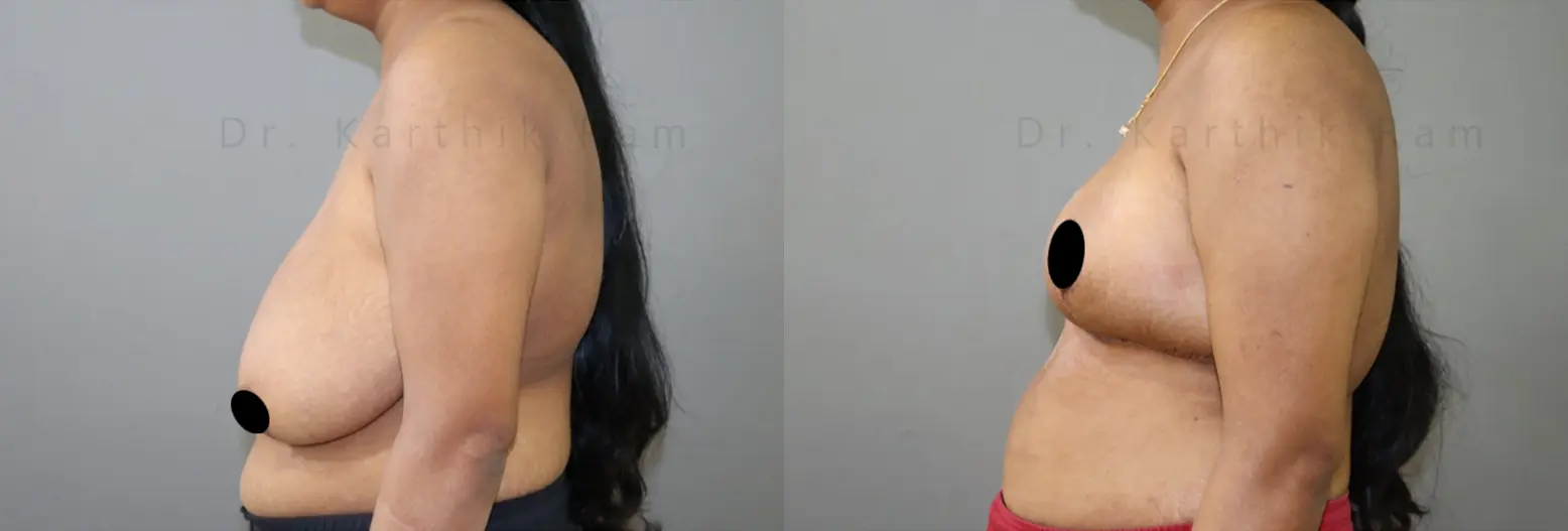 breast reduction before and after photo by chennai plastic surgery in india