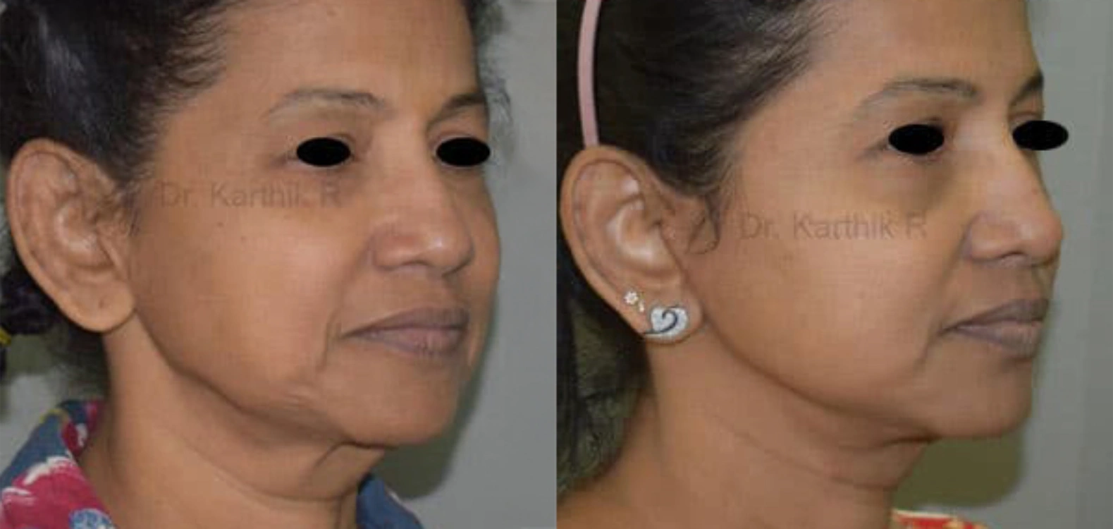 before and after facelift