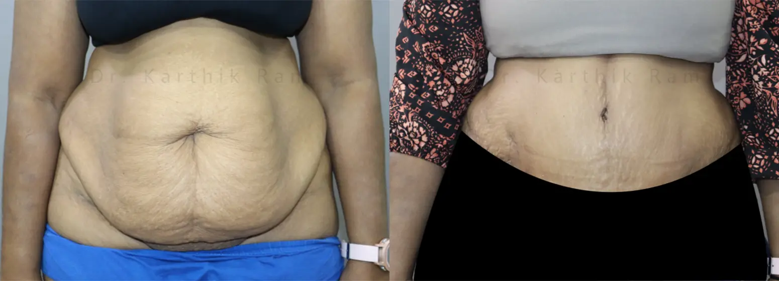 tummy tuck before and after photo by chennai plastic surgery in india