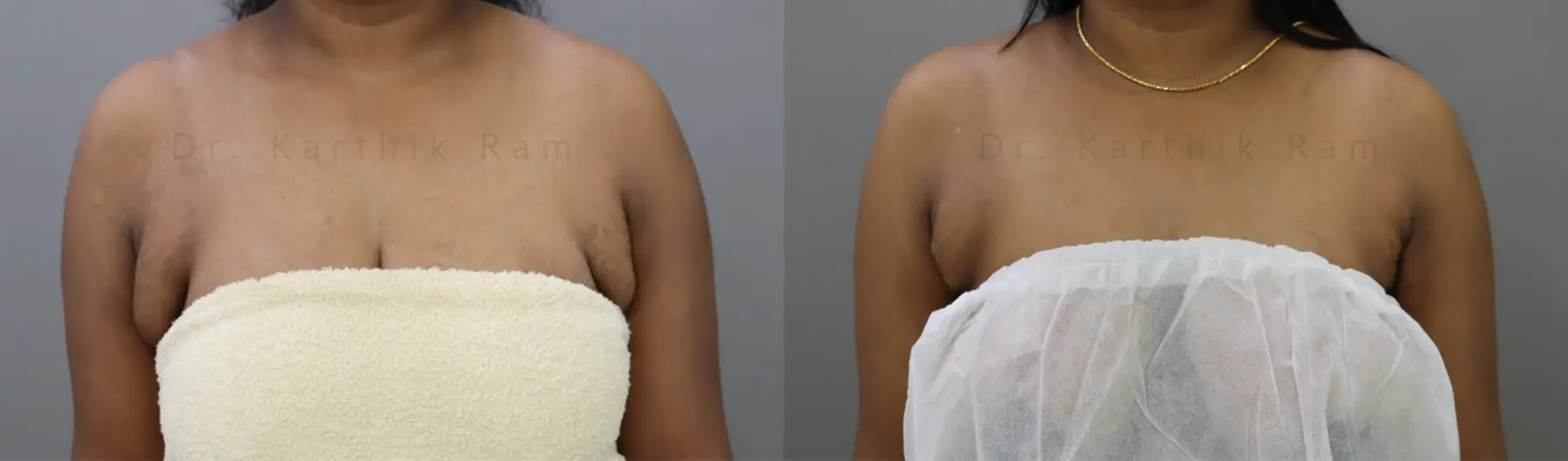 axillary tail of breast before and after photo by chennai plastic surgery in india