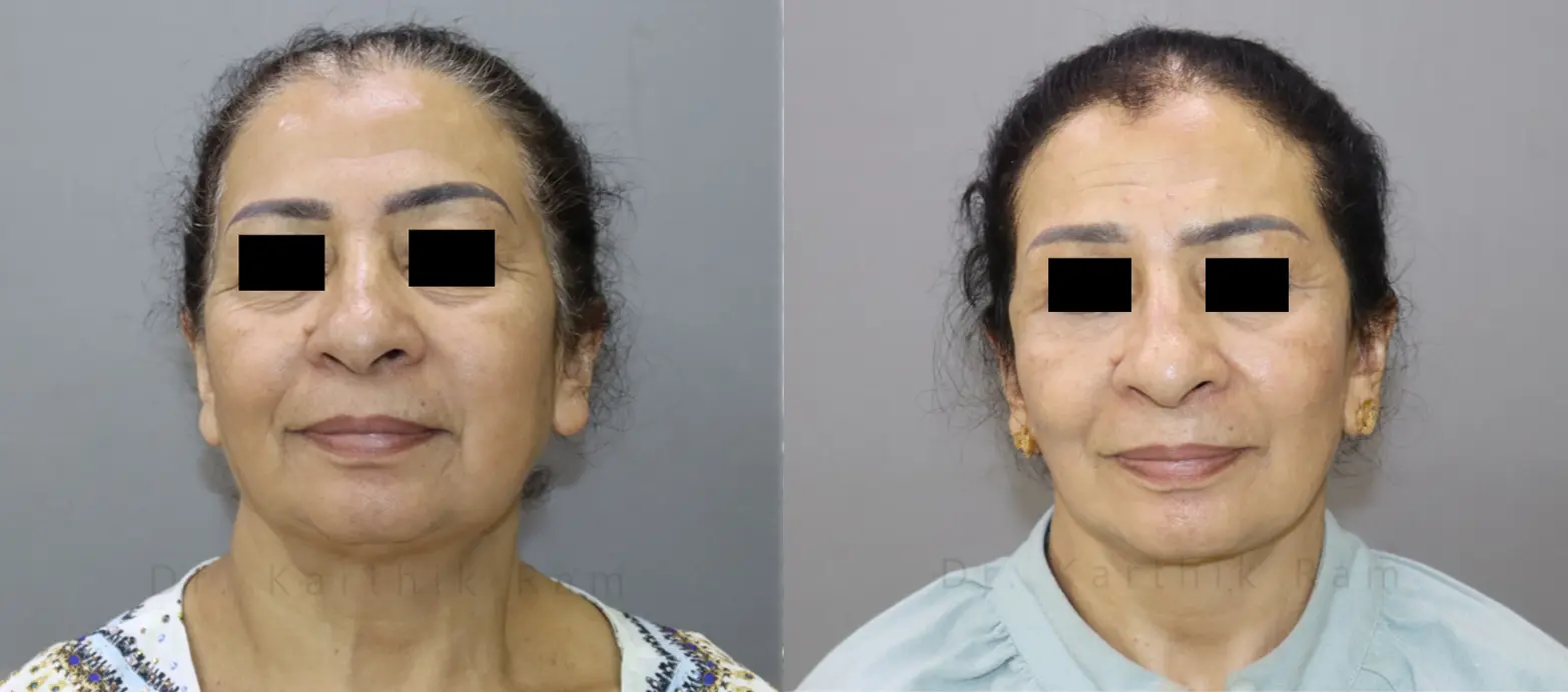 facelift before and after photo by chennai plastic surgery in india