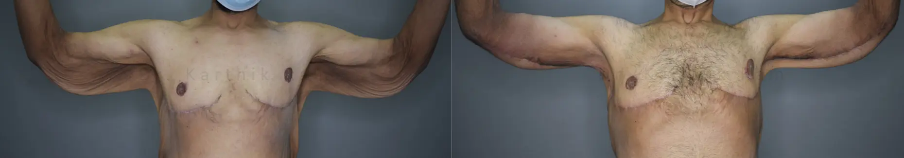 circumferential body lift before and after photo by chennai plastic surgery in india