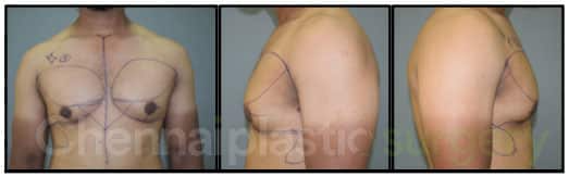 gynecomastia grade gynecomastia grade