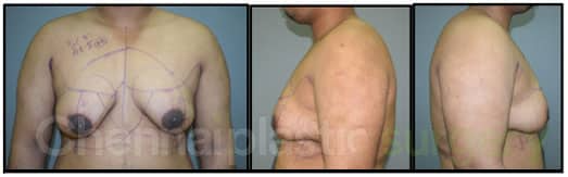 gynecomastia grade gynecomastia grade
