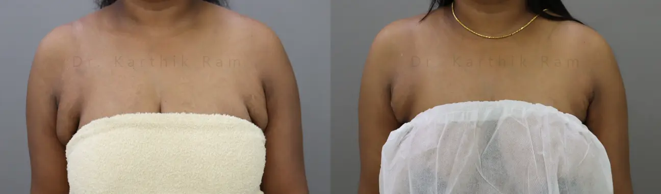 axillary tail of breast before and after photo by chennai plastic surgery in india