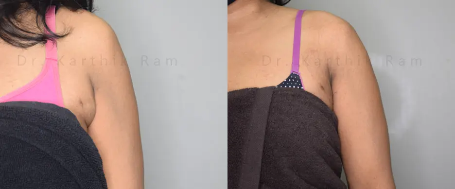 axillary tail of breast before and after photo by chennai plastic surgery in india