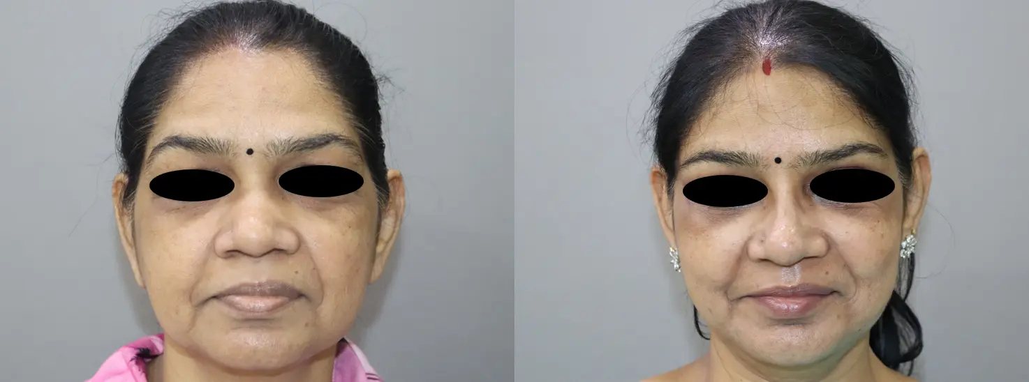 brow lift before and after photo by chennai plastic surgery in india