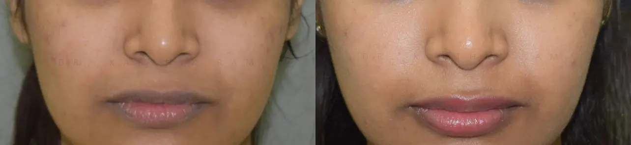 dermal fillers before and after photo by chennai plastic surgery in india
