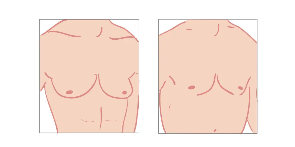 gynecomastia