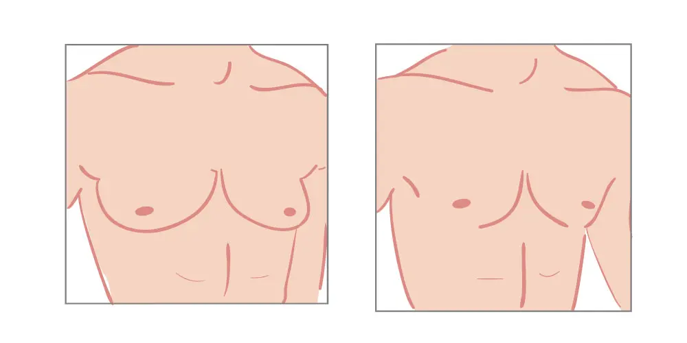 gynecomastia myth