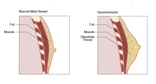 gynecomastia