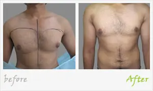 Almost pain free Procedure