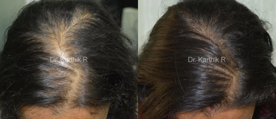 dermaroller scalp before and after photo by chennai plastic surgery in india
