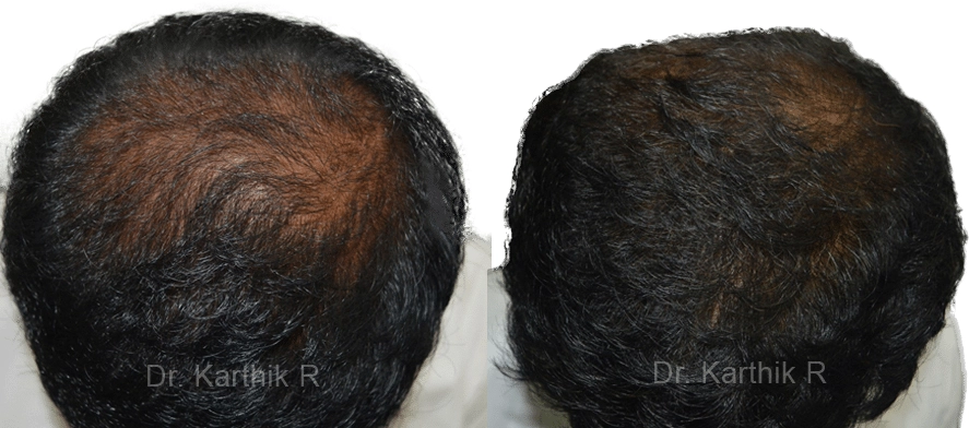 dermaroller scalp before and after photo by chennai plastic surgery in india