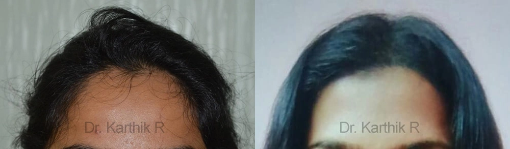 female hair transplant before and after photo by chennai plastic surgery in india