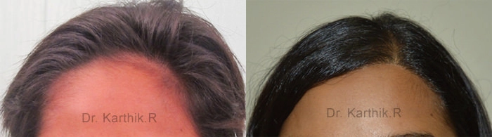 female hair transplant before and after photo by chennai plastic surgery in india