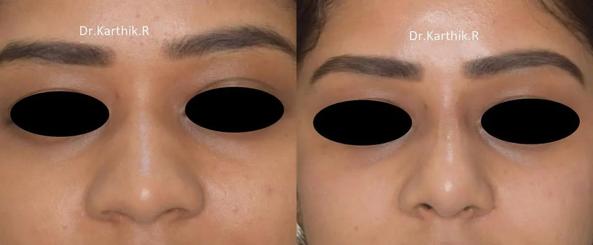 rhinoplasty before and after photo by chennai plastic surgery in india