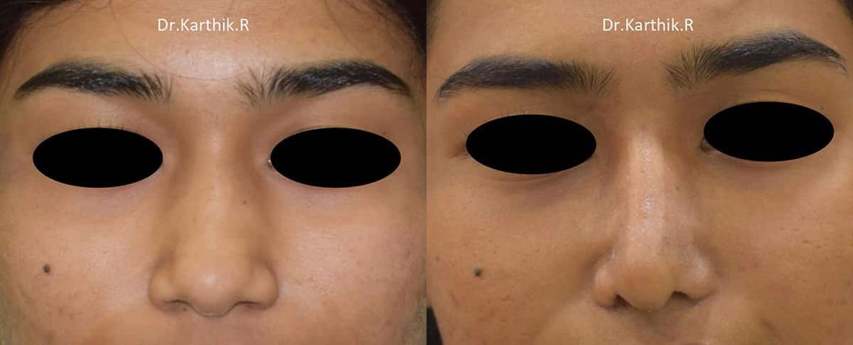 rhinoplasty before and after photo by chennai plastic surgery in india