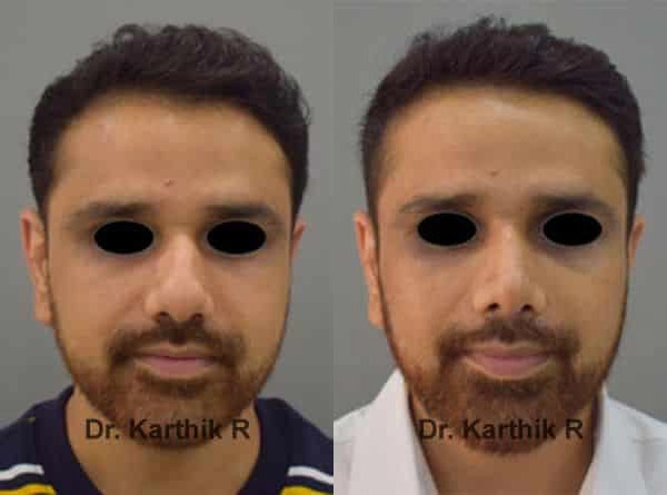 rhinoplasty before and after photo by chennai plastic surgery in india